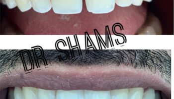Dr. Shams Tabrez – B.D.S, M.D.S. (Orthodontics), C-ICOI-(Implantology)