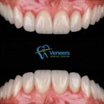 Veneers Dental Centre