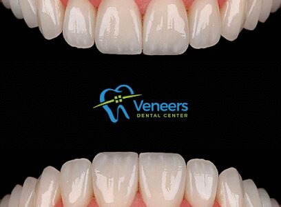 Veneers Dental Centre