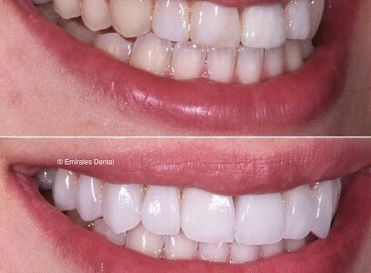 Emirates Dental – Cosmetic Dentistry & Invisalign Clinic Dubai